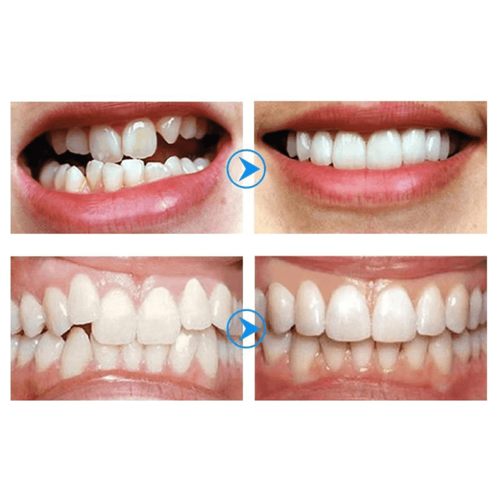 Before-and-after images of teeth alignment.