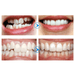 Before-and-after images of teeth alignment.