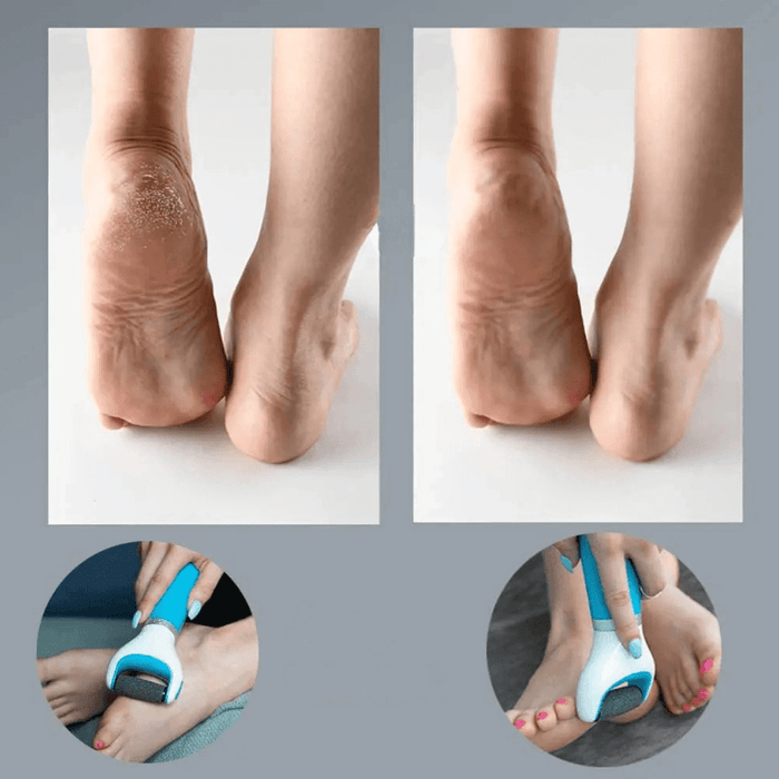 Before and After Foot Care: Side-by-side images of feet, highlighting the difference in heel condition before and after using a foot file.